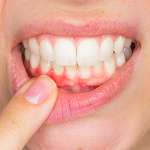 Periodontal disease — What Do I Need To Know?